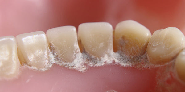 9 Simple Steps to Remove Hard Plaque from Teeth