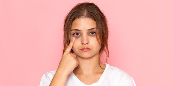 How to Reduce Dark Circles Naturally