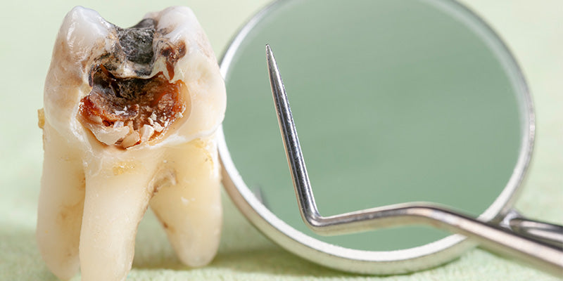 How to Prevent Tooth Decay Naturally?